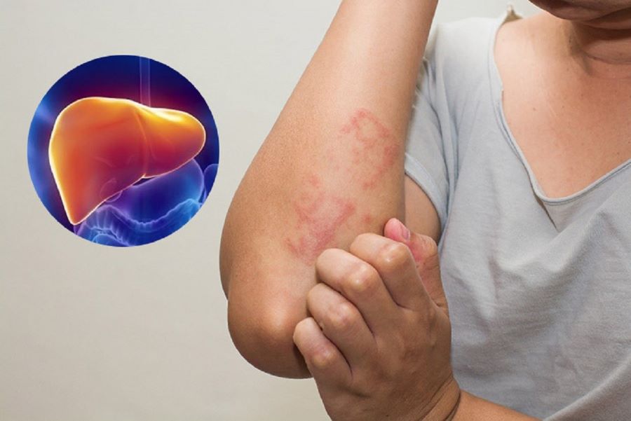 Cẩn trọng khi ăn hải sản khi tiền sử cơ thể bị dị ứng với hải sản.